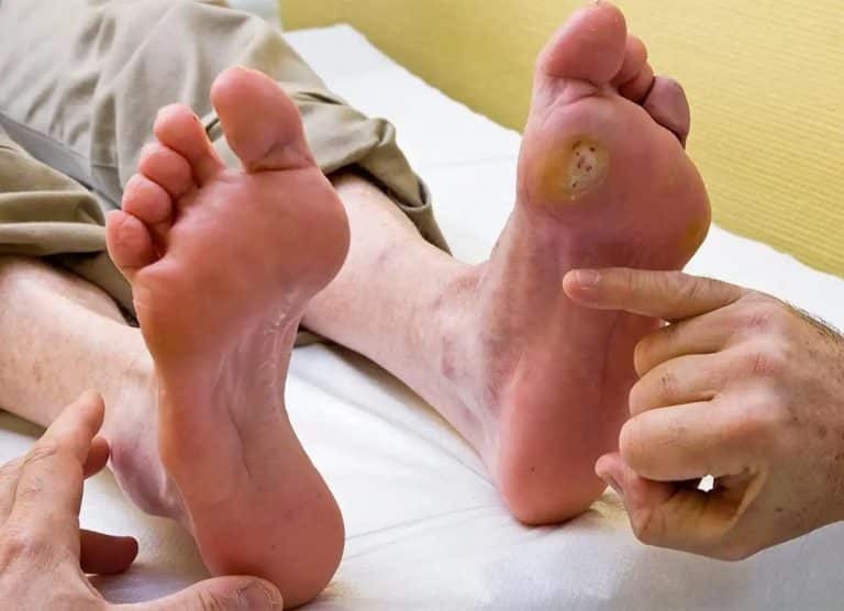 Médico examina paciente com ferida de pé diabético abaixo do dedão