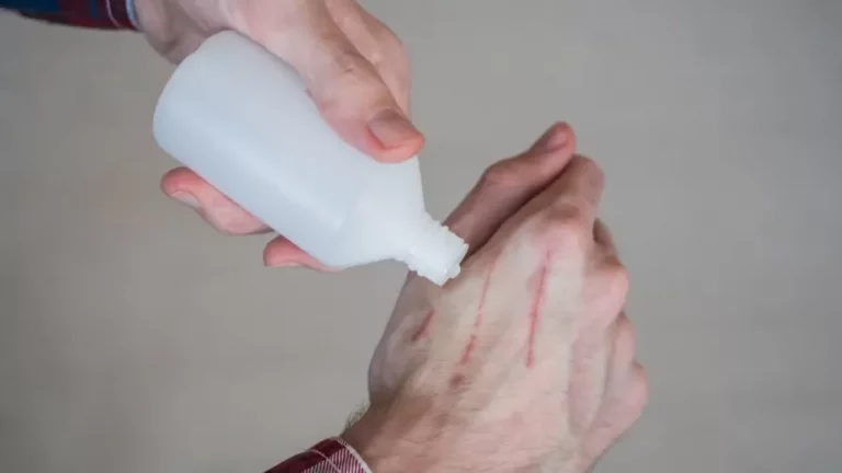 Pessoa passando água oxigenada em ferida na mão