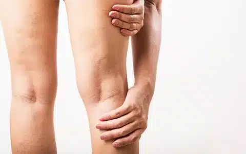 Mulher colocando as mãos nas pernas com má circulação sanguínea