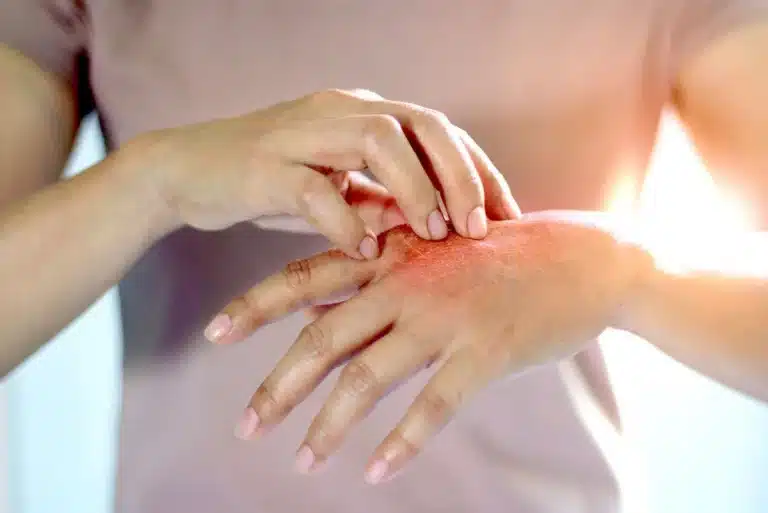 Mulher coçando a mão com feridas na pele que aparecem do nada