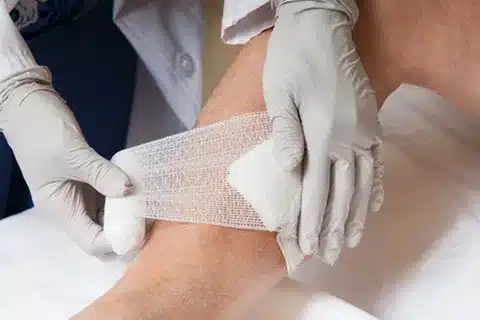 enfermeiro coloca faixa na perna de paciente para tratar fibrina na ferida