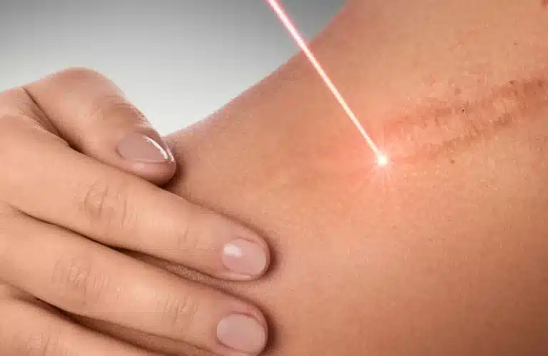 Aplicação de laser em ferida